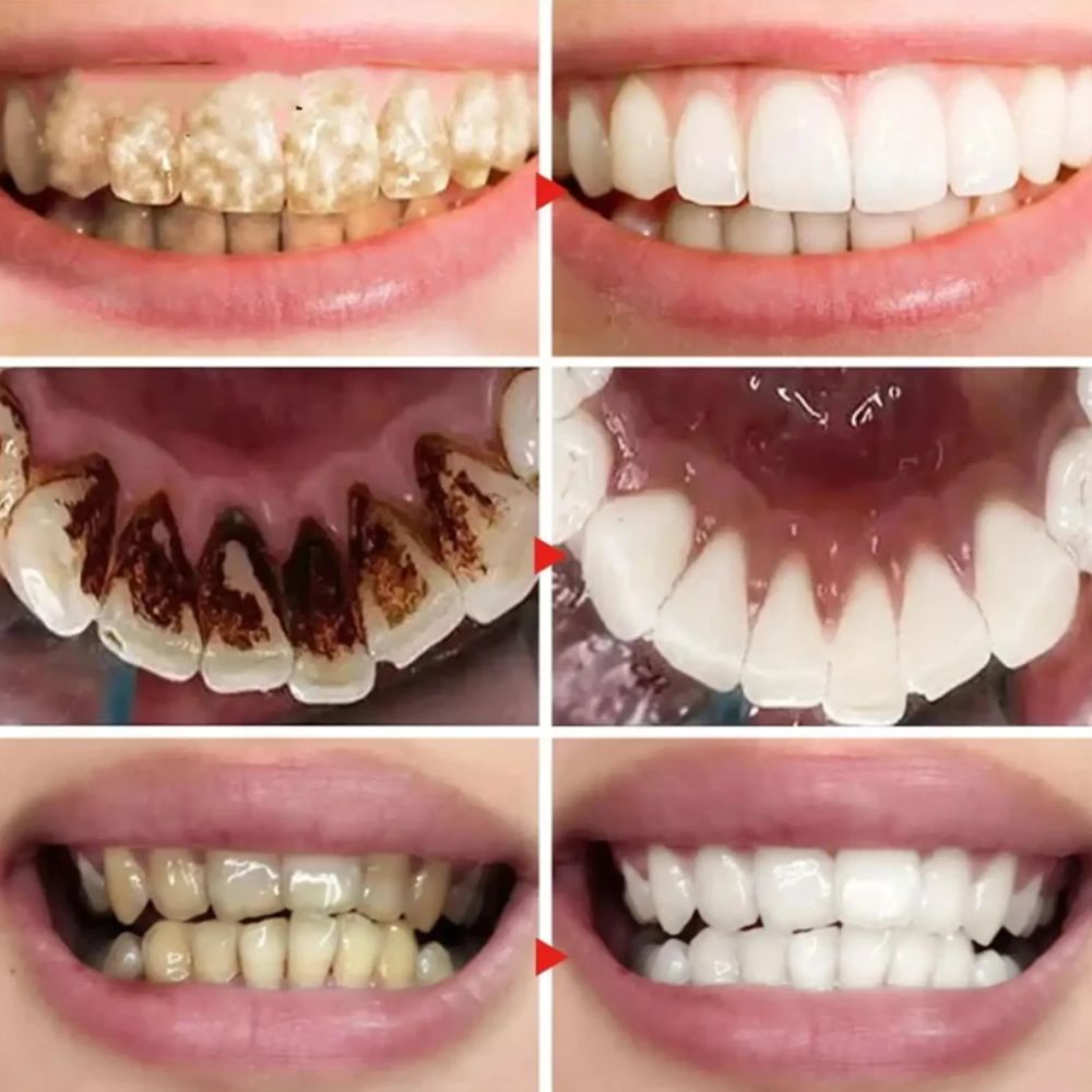 Espuma Blanqueadora Dental V34 Lilás - Luce Dientes Brillantes Ahora Mismo