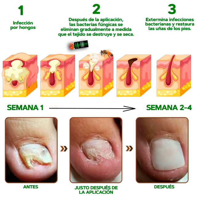 OFERTA ESPECIAL 2X1🎁GERMX® Gotas Anti Hongos Para pies y manos