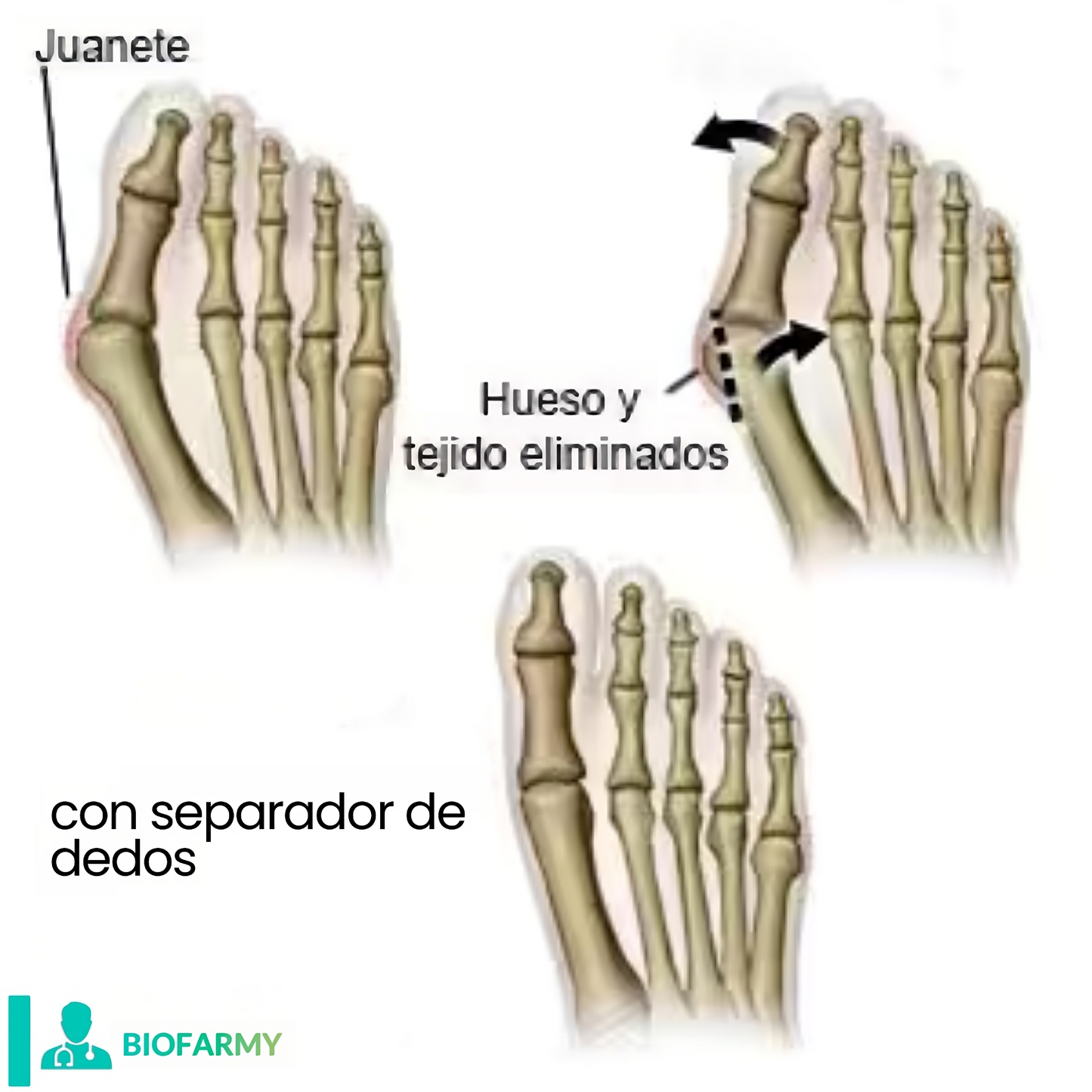 Separadores de dedos BioFarmy®👉 PROMOCIÓN ESPECIAL 2X1🤯🔥