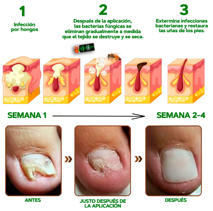 OFERTA ESPECIAL 2X1🎁GERMX® Gotas Anti Hongos Para pies y manos